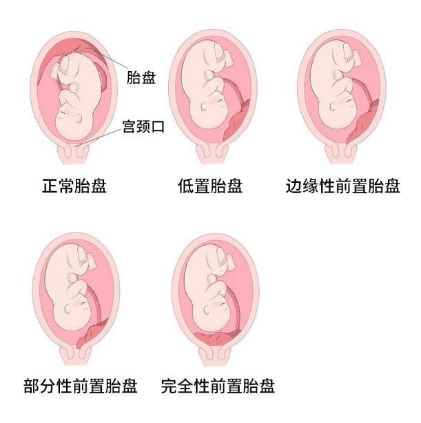 如果 b 超报告单中描述的是"胎盘前置"胎盘下缘覆盖宫颈内口"等,都