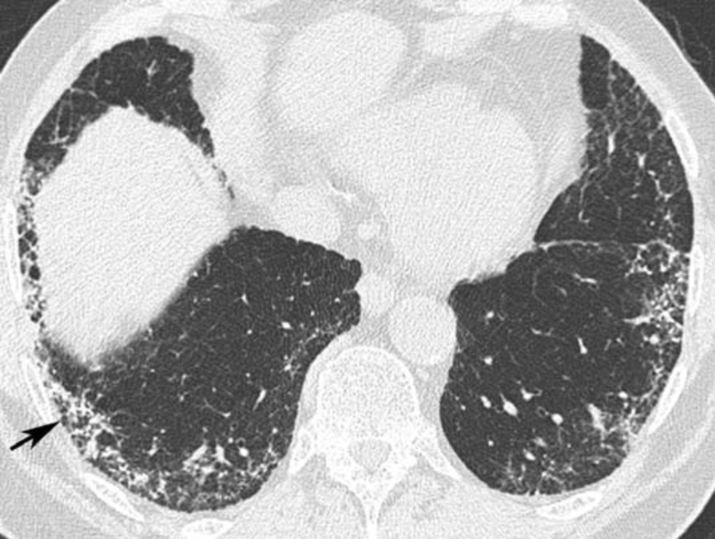 特发性肺纤维化的危险因素和病因