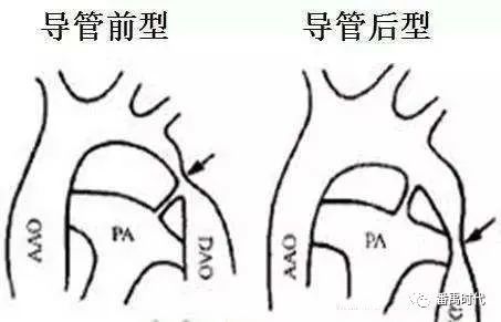 先心病主动脉缩窄特点