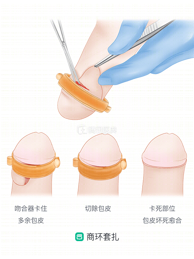 套扎器类:使用一次性的包皮环切套扎器是对传统包皮环切术的一种创新