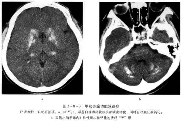 表现:头颅  ct 表现主要表现为: 颅内对称斑块状钙化,在基底节,小脑齿