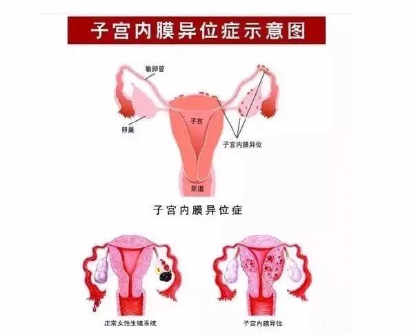 子宫内膜异位症的发病原因尚不明确,但公认的有这4点!