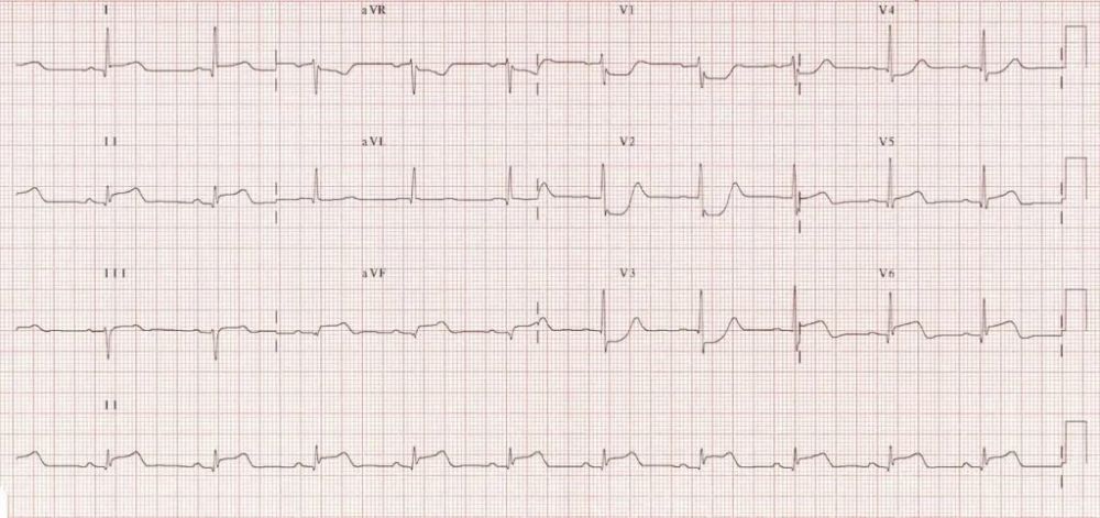 后壁心肌梗死的心电图表现你知晓了吗