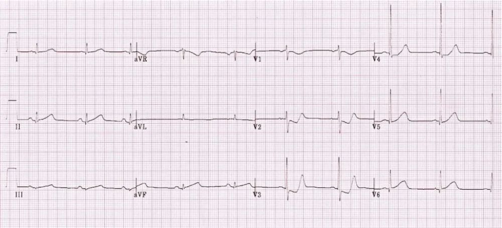 后壁心肌梗死的心电图表现你知晓了吗