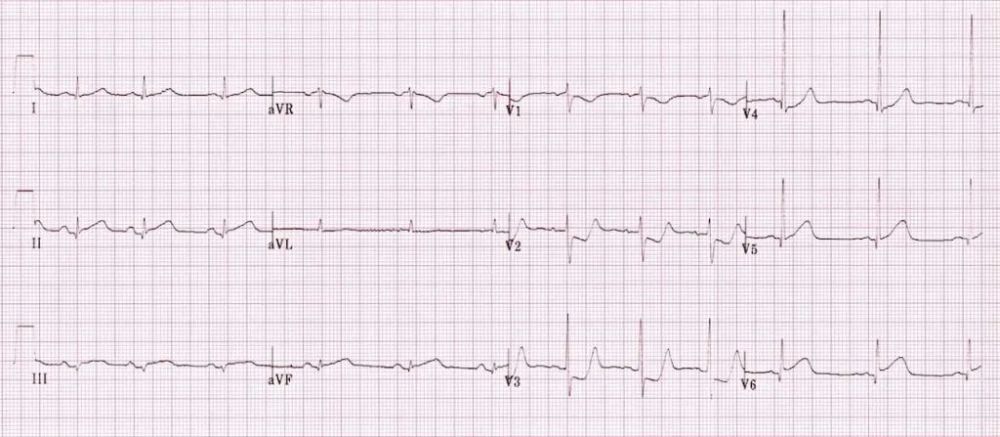 v1-v2导联无显性r波,但该心电图可能是心梗早期,在病理性r波形成前