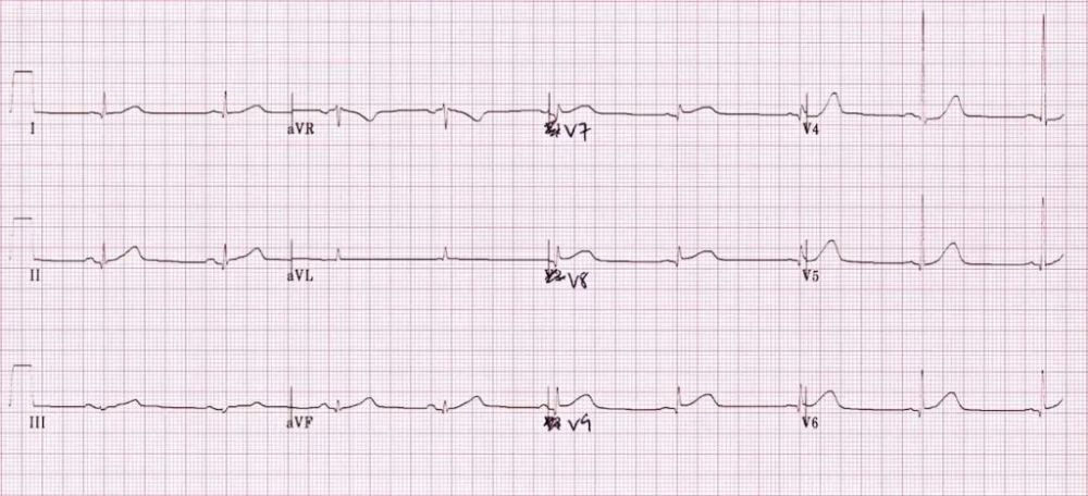 v1-v2导联无显性r波,但该心电图可能是心梗早期,在病理性r波形成前
