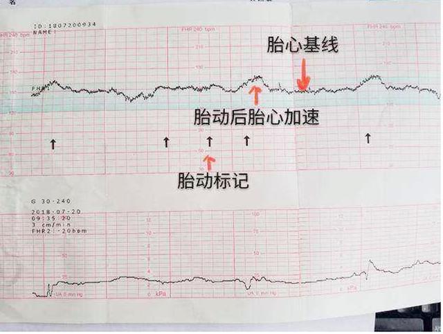 胎心监护图怎么看?这几个数据看懂,自己就能了解胎儿的健康情况