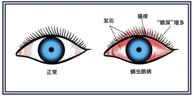 睫毛炎发病图片 腾讯网