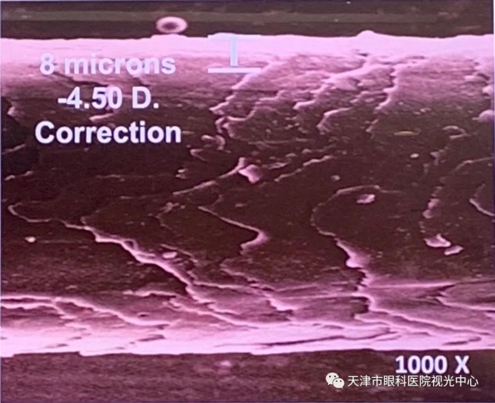 倍的图片,它的直径是75微米,如此的改变对于平均厚度500微米的角膜来