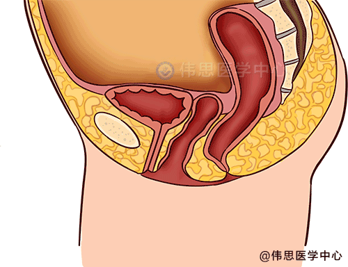 尿道,导致患者在咳嗽或运动时,膀胱从尿道口不自觉溢出;由于膀胱下垂