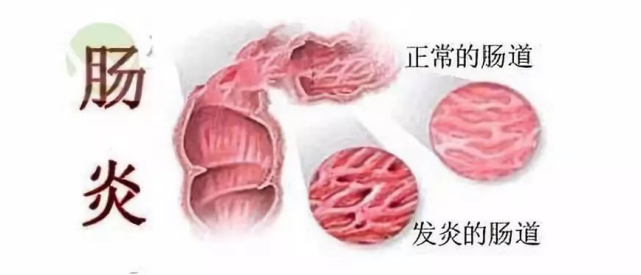 如何治疗慢性直肠炎