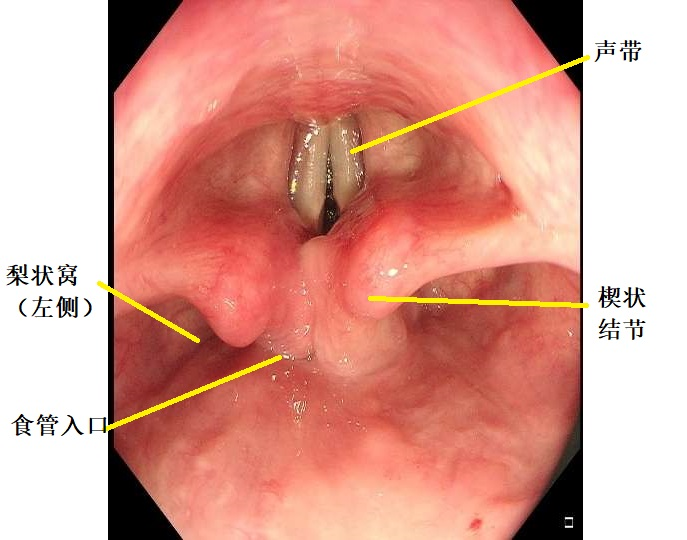 胃镜进入口腔后可沿舌正中位置到达舌根即可看到会厌软骨,继续进镜可