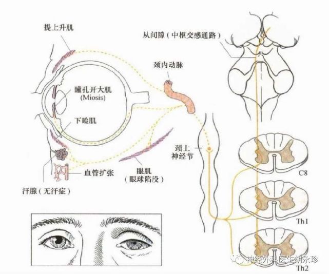 眼裂减小颜面无汗瞳孔缩小要注意这类疾病