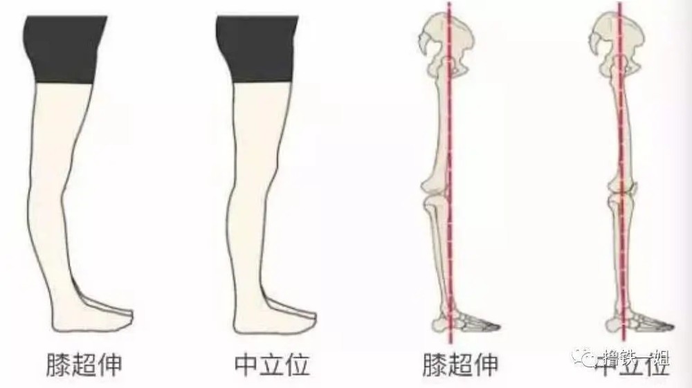 足弓塌陷,扁平足,足外翻都会造成小腿外翻