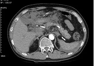 往下的ct图像显示,腹腔内积液越来越明显,结合病人存在的休克表现