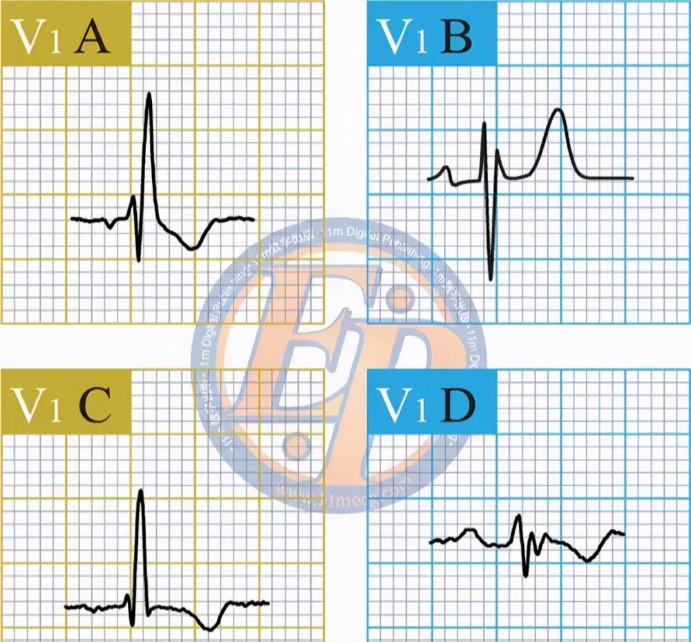 右心室内的激动 心电图v1导联qrs 波呈rsr  形,qrs 波间期 房间隔