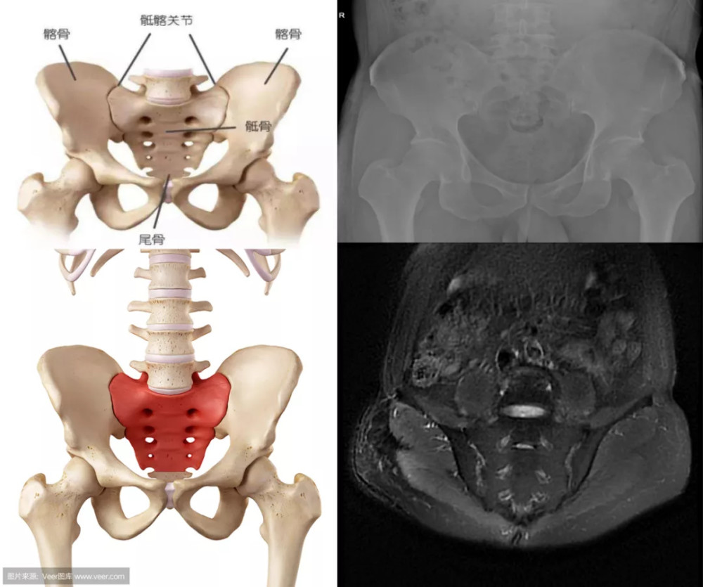 骶髂关节 mri 如何诊断早期强直性脊柱炎