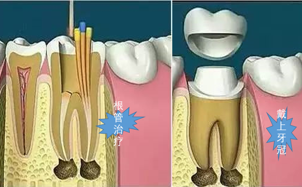 牙髓发炎,吃点药就好,口腔医生:必须根管治疗