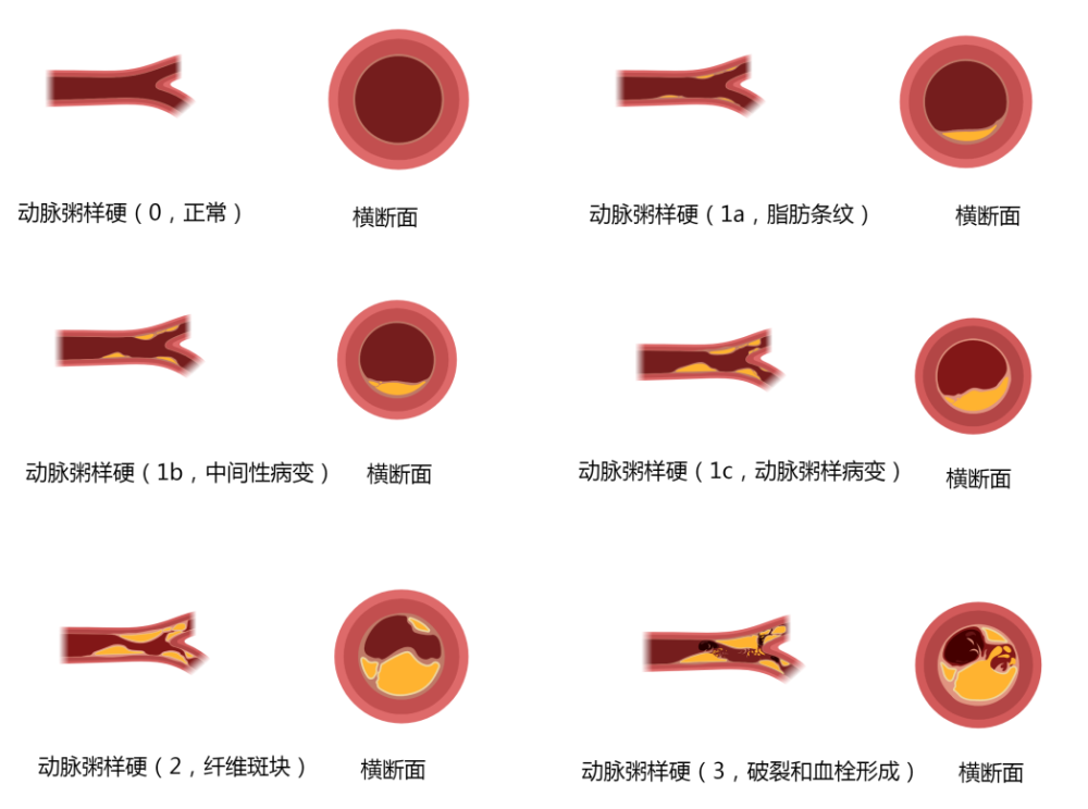 动脉粥样硬化