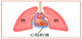 心包积液是什么原因引起的