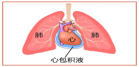心包积液是什么原因引起的|心包|急性心肌梗塞|胸膜