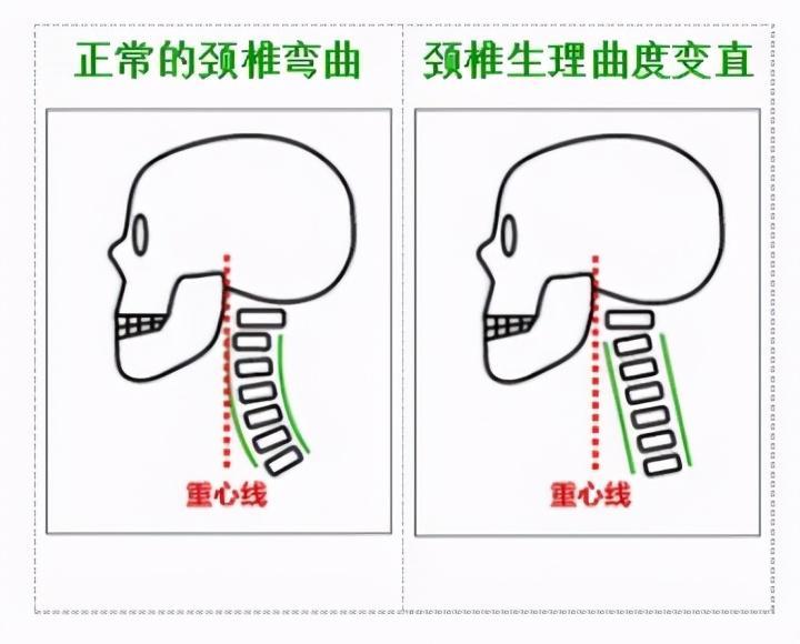 颈椎是有弧度的,而这种 弧度向前弯曲,像一个拉开的弓一样