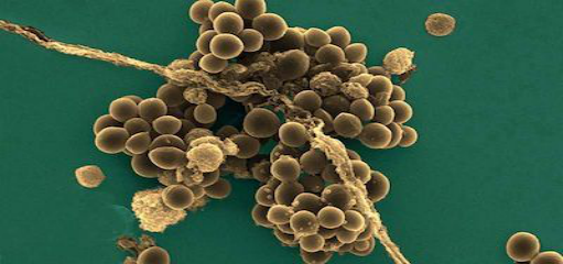 临床表现另外,皮肤感染灶(疖,痈,蜂窝织炎,伤口感染)中的葡萄球菌可