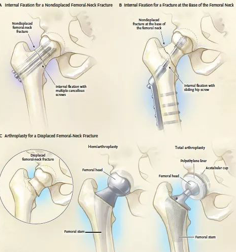 股骨颈骨折应该怎么治疗