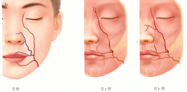 图1-53b面动脉Ⅱ型:鼻唇沟型伴眶下型(29.