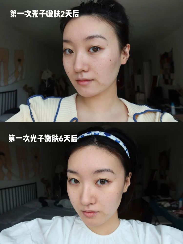 千万不要去做光子嫩肤!