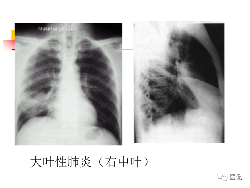 大叶性肺炎的影像诊断