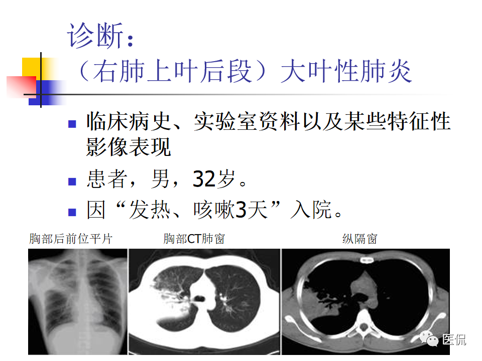 大叶性肺炎的影像诊断