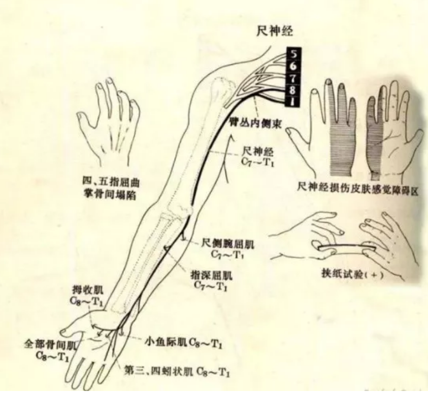 有许多个潜在的卡压部位,而这之中最重要的就是位于胳膊肘的"尺神经沟