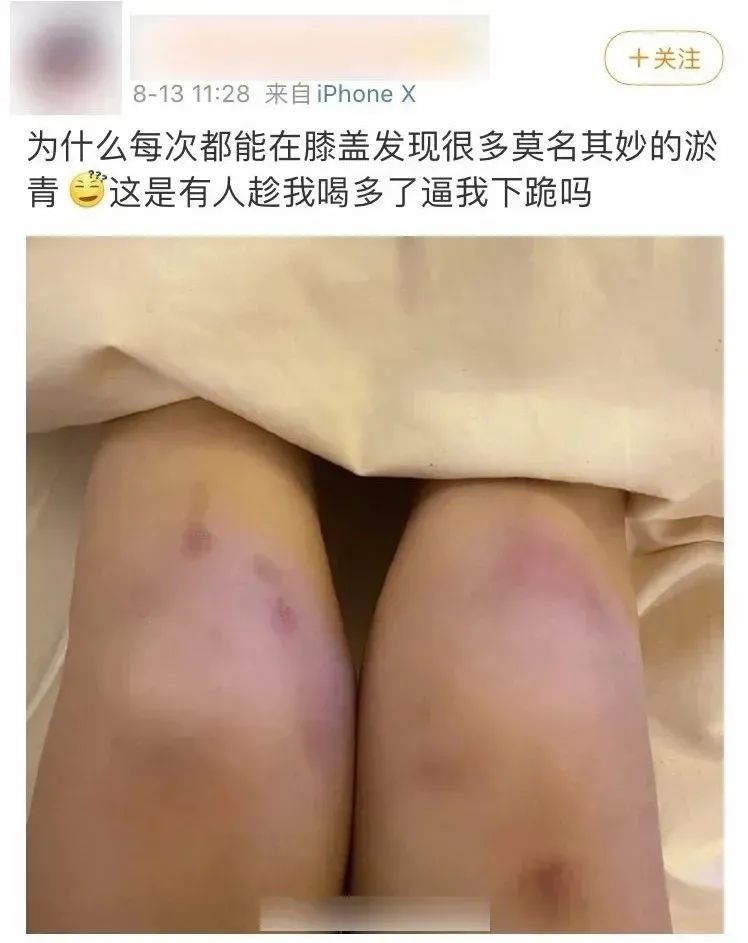 女友膝盖上的淤青,被绿的真相