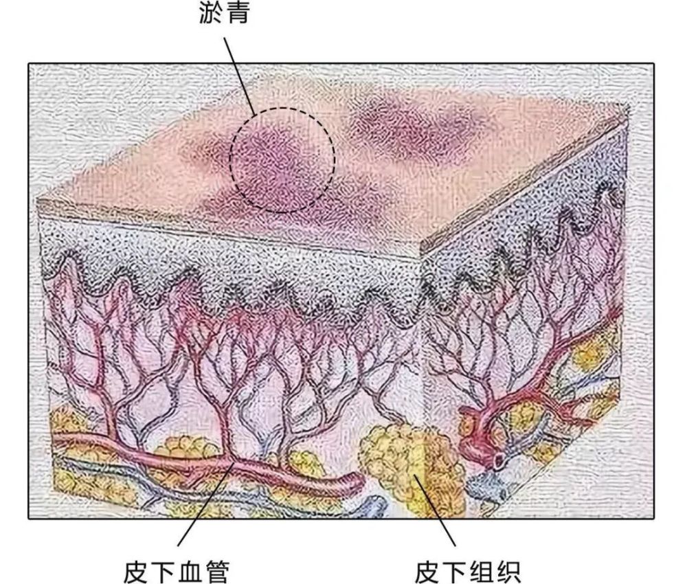 是红色的因为血液里面有血红素但是随着时间的推移淤血里死亡的红细胞