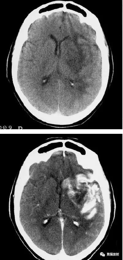 左侧大脑中动脉区域大面积梗死,明显不均质强化