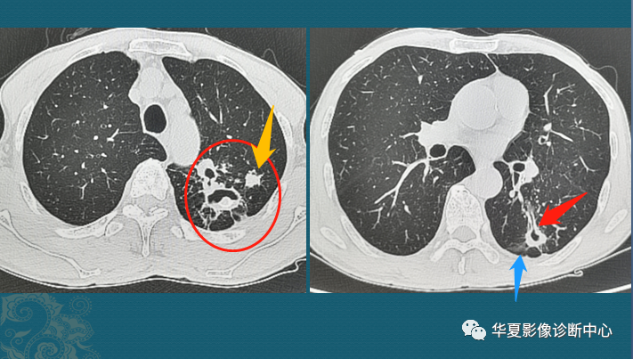 肺结核与肺癌,ct片怎么区分?医生教你4个读片小窍门
