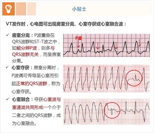 室速与室上速的快速鉴别方法|室速|心动过速|心电图|窦性心律|心室