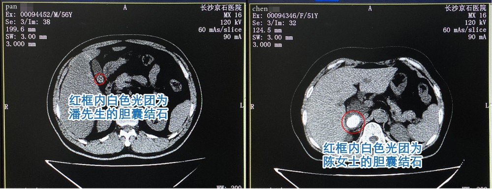 炒一碗菜放半碗油,女子与丈夫双双患上胆结石