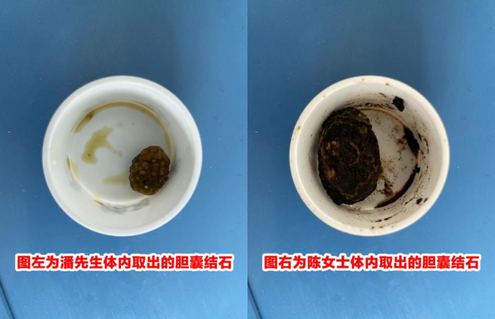 炒一碗菜放半碗油,女子与丈夫双双患上胆结石