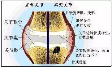 什么是膝关节滑膜炎?