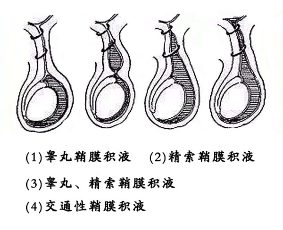 鞘膜积液会导致不育?鞘膜积液的注意事项