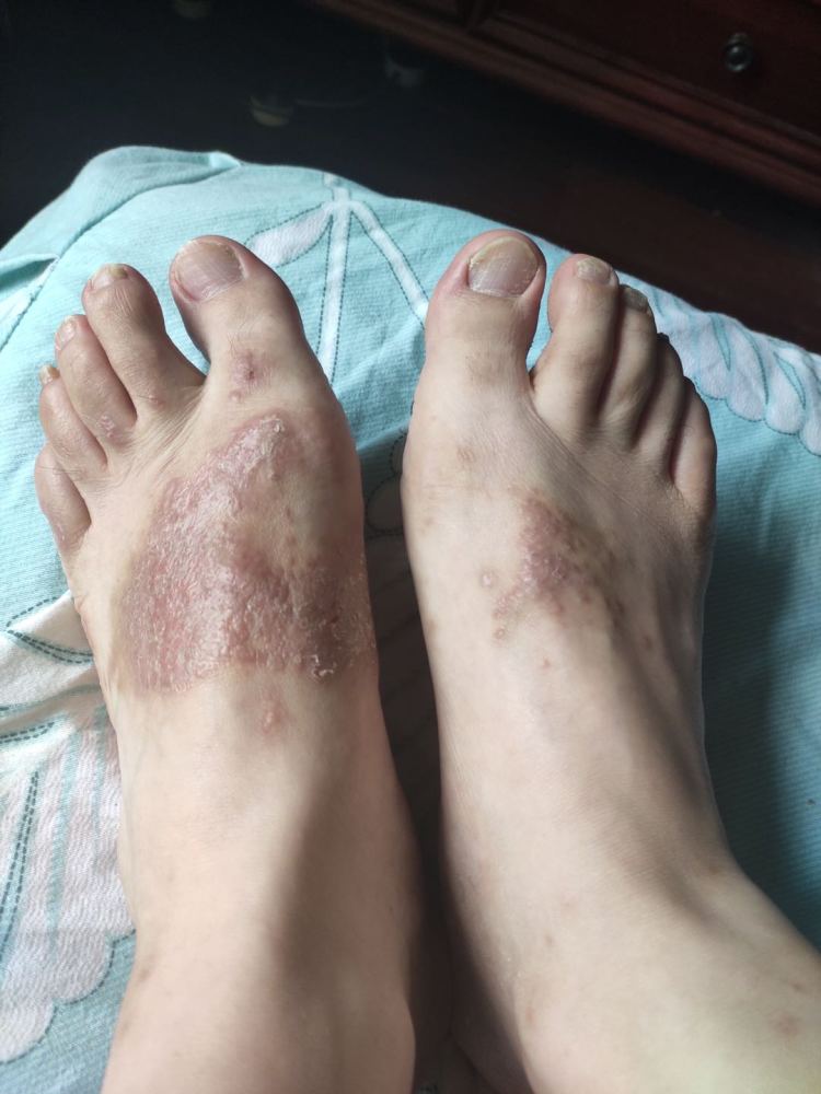 我本人的双脚脚背部湿疹,夏天发出来的,大概三个多月了,一直没有好.