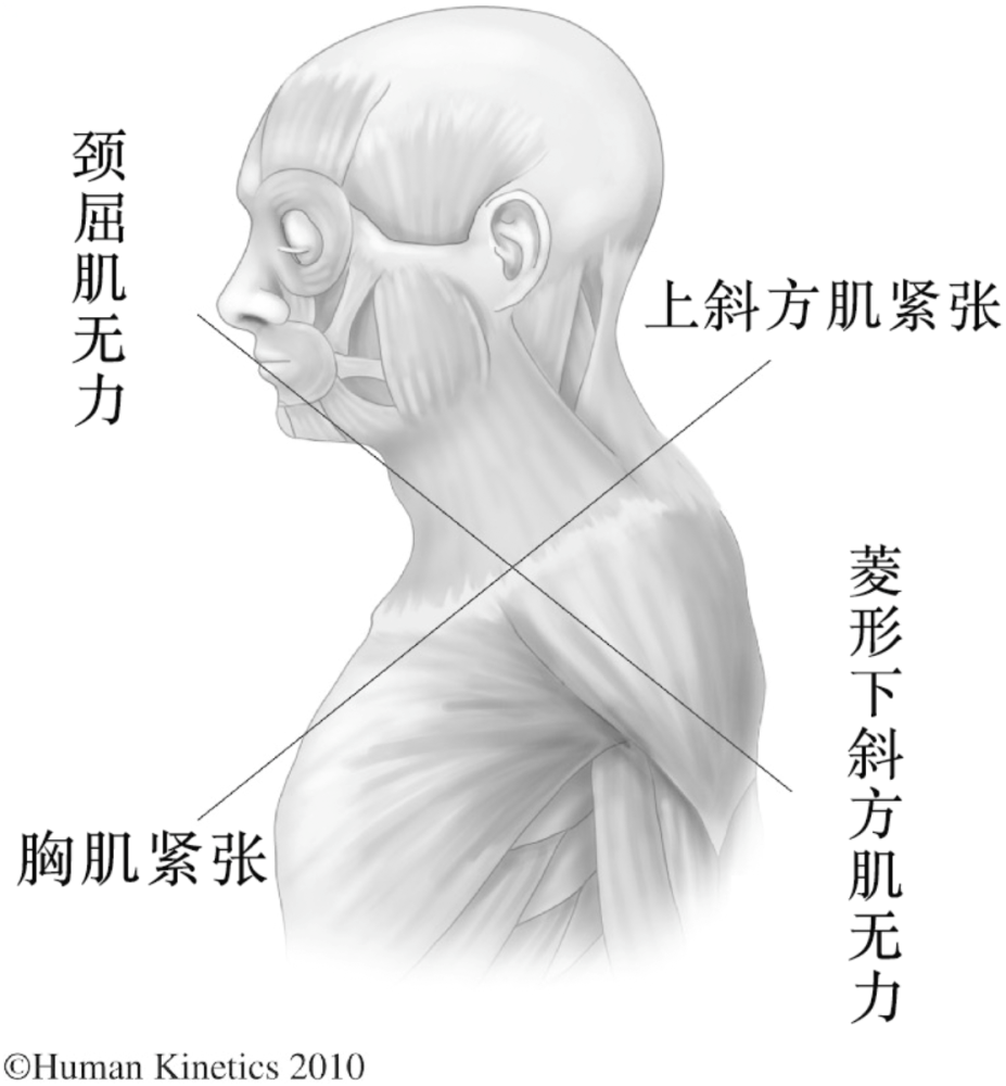 前侧胸小肌胸大肌紧张,而背侧肌群无力所以不管是不是为了追求直角肩