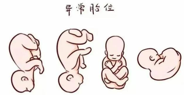 胎位不正怎么纠正（胎位不正怎么纠正方法）