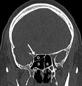 冠状未增强ct扫描显示蝶窦(s)中的右侧蝶窦(onodi)小室(o.