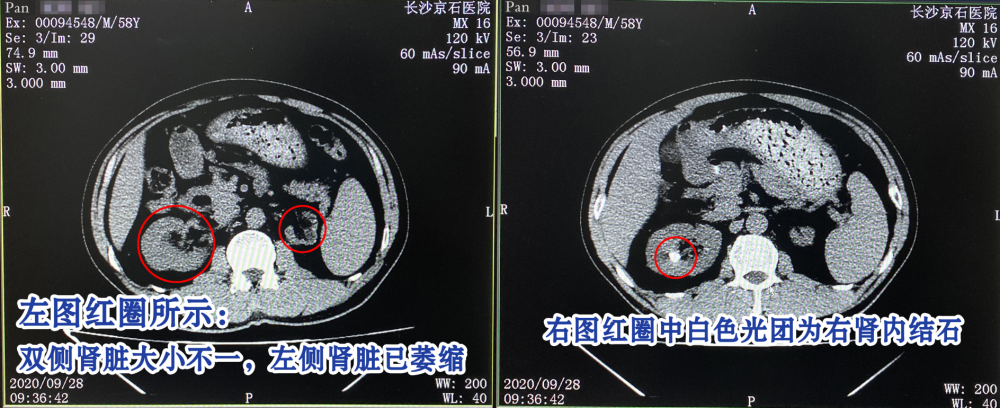 结石发作痛过一次后放松警惕结果左肾萎缩如今右肾又遇结石危机