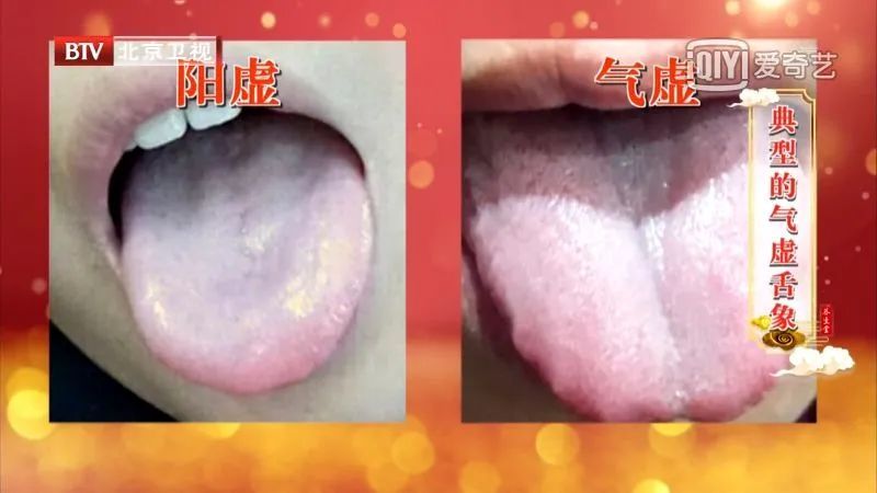 舌头上有裂纹或是多种疾病征兆发现这4种舌象当心痰湿脾虚找上门
