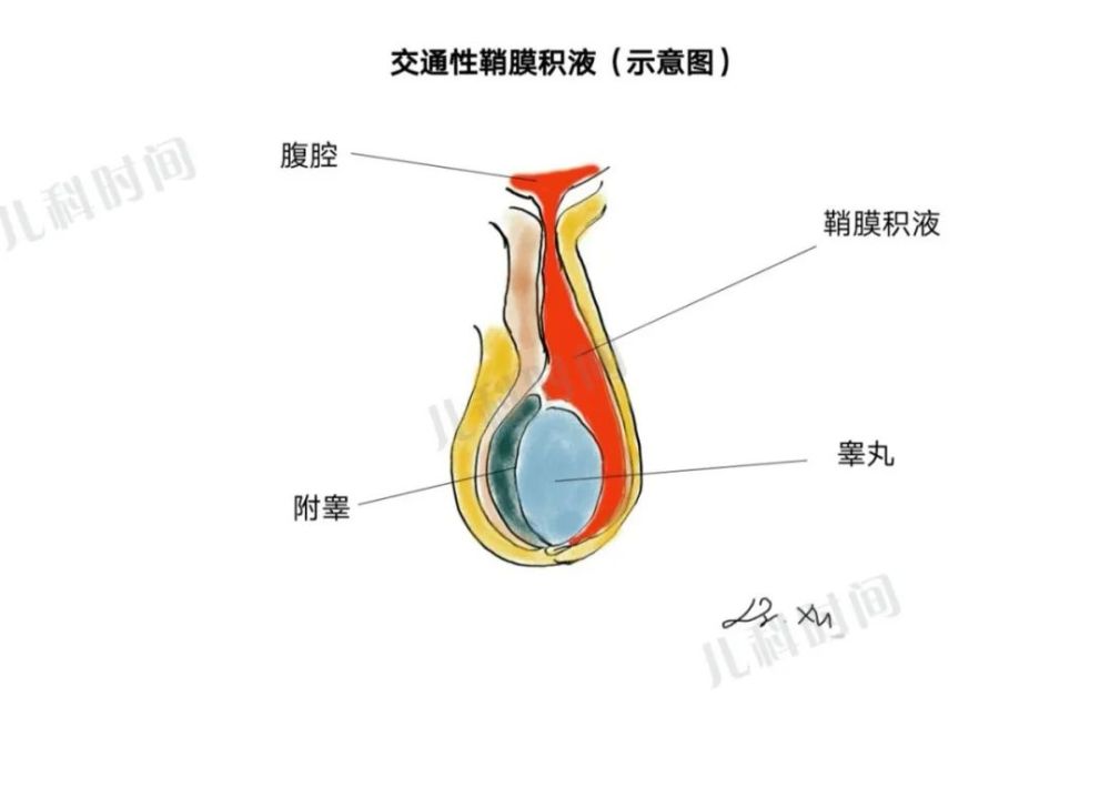 精索鞘膜积液,睾丸鞘膜积液,精索睾丸鞘膜积液,交通性鞘膜积液四种.