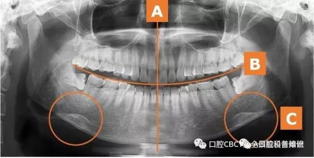 口腔全景片到底有什么用